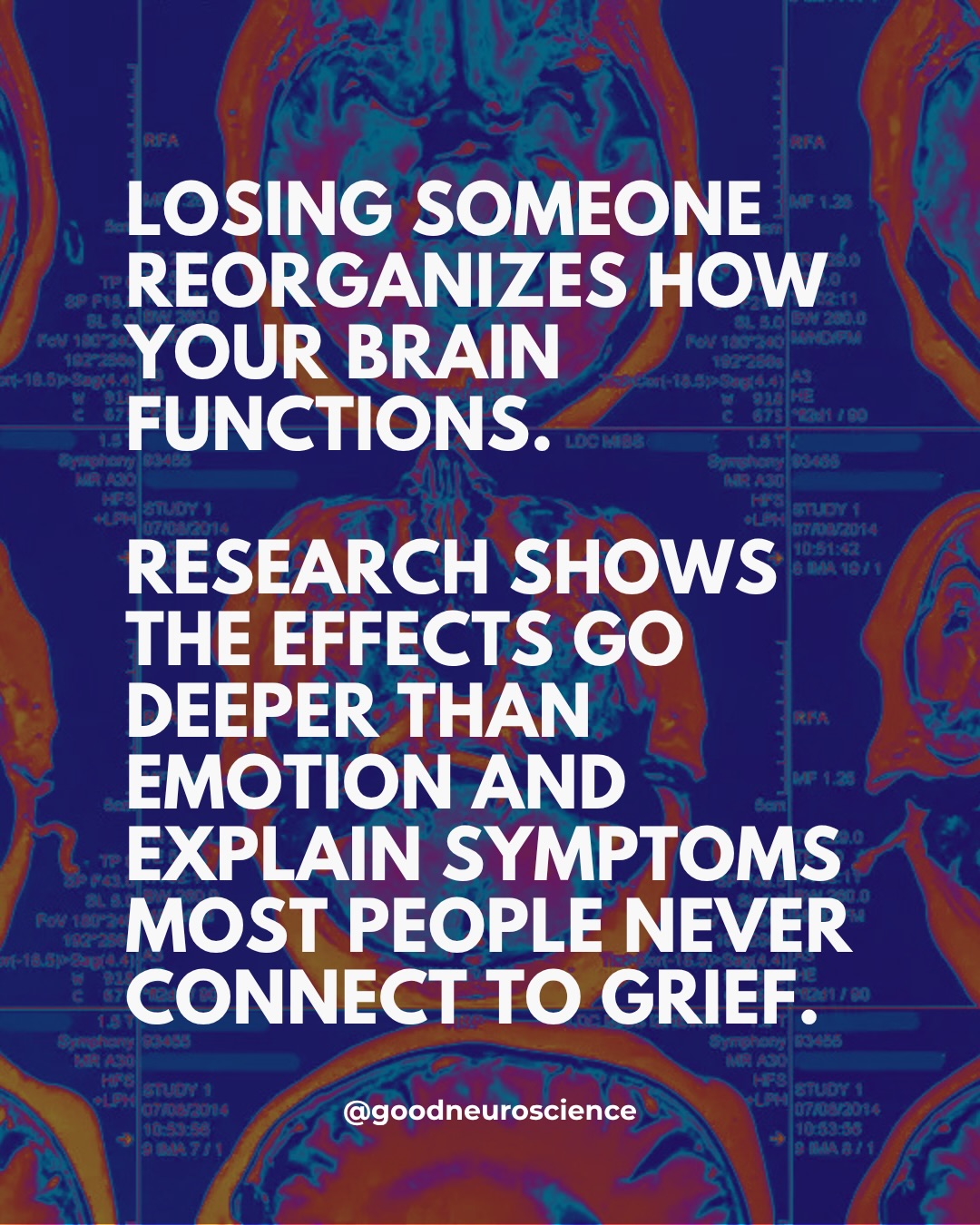 First slide of a carousel by @goodneuroscience: LOSING SOMEONE REORGANIZES HOW YOUR BRAIN FUNCTIONS. RESEARCH SHOWS THE EFFECTS GO DEEPER THAN EMOTION AND EXPLAIN SYMPTOMS MOST PEOPLE NEVER CONNECT TO GRIEF.